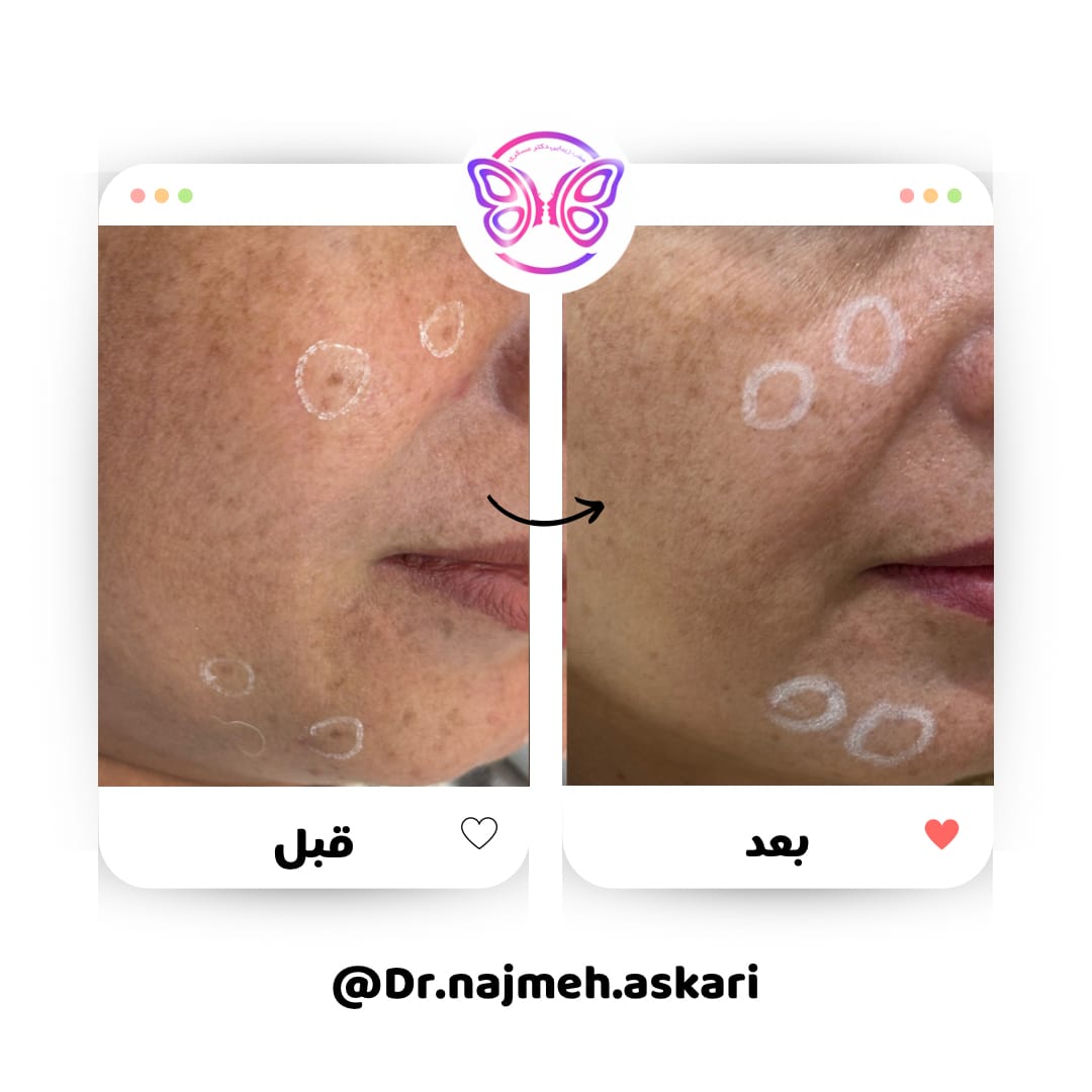 نتیجه لیزر کک و مک با دستگاه الیت پلاس از کمپانی سایناشور آمریکا
بدون درد و خونریزی
با بهترین دستگاه موجود در ایران
آدرس کلینیک دکتر نجمه عسکری✨️
📌رفسنجان، خیابان امام خمینی نبش کوچه ۲۲
✅️رزرو خدمات لیزر موهای زائد
📞09136422700
⚠️👩🏻⚕️رزرو نوبت خدمات پزشک
📞09136812700